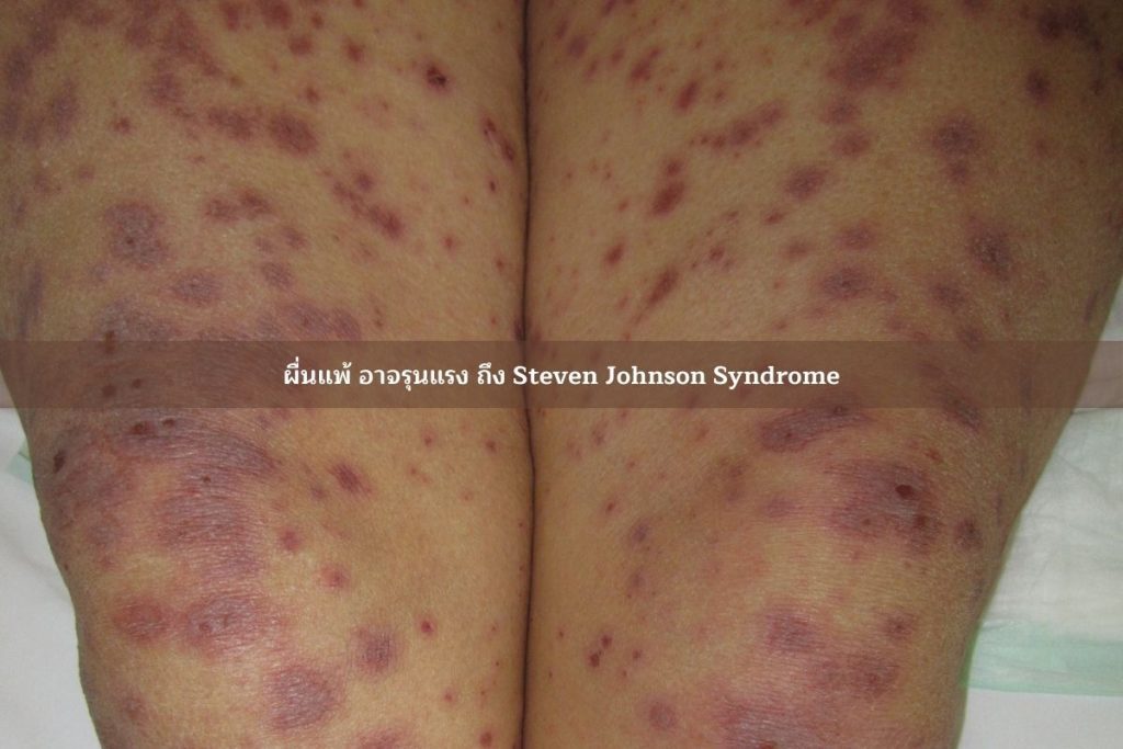 ผื่นsteven johnson syndrome