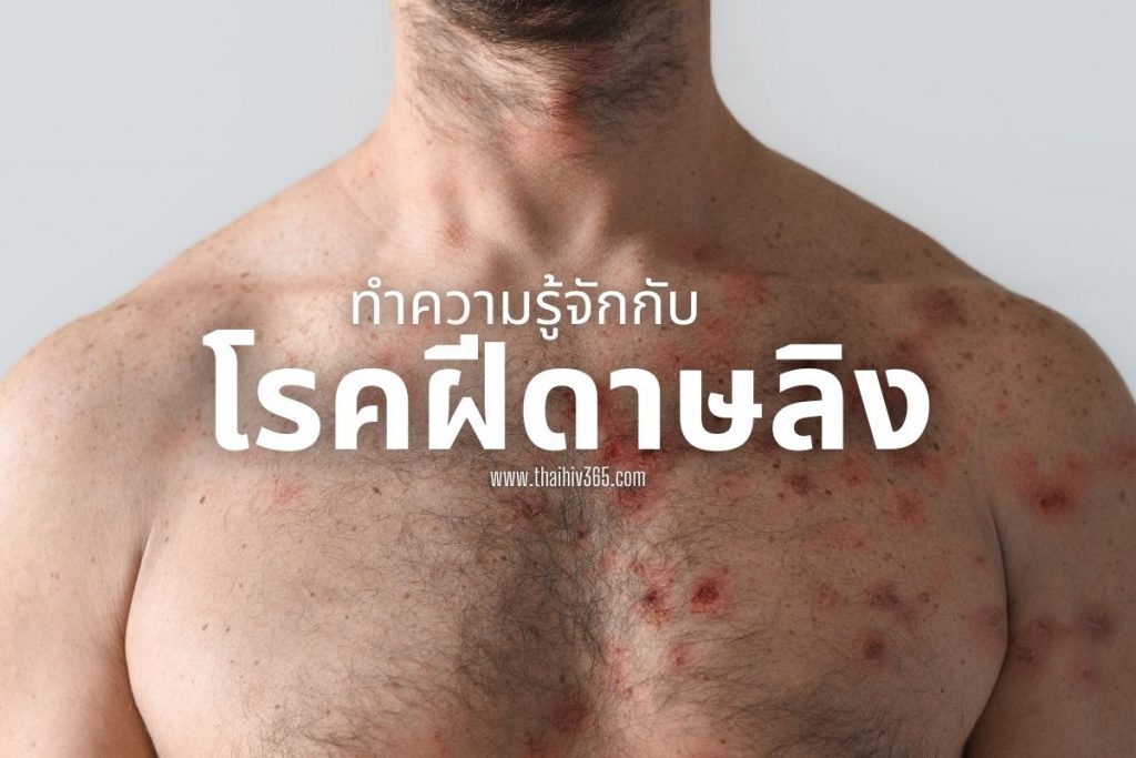 ทำความรู้จักกับ โรคฝีดาษลิง