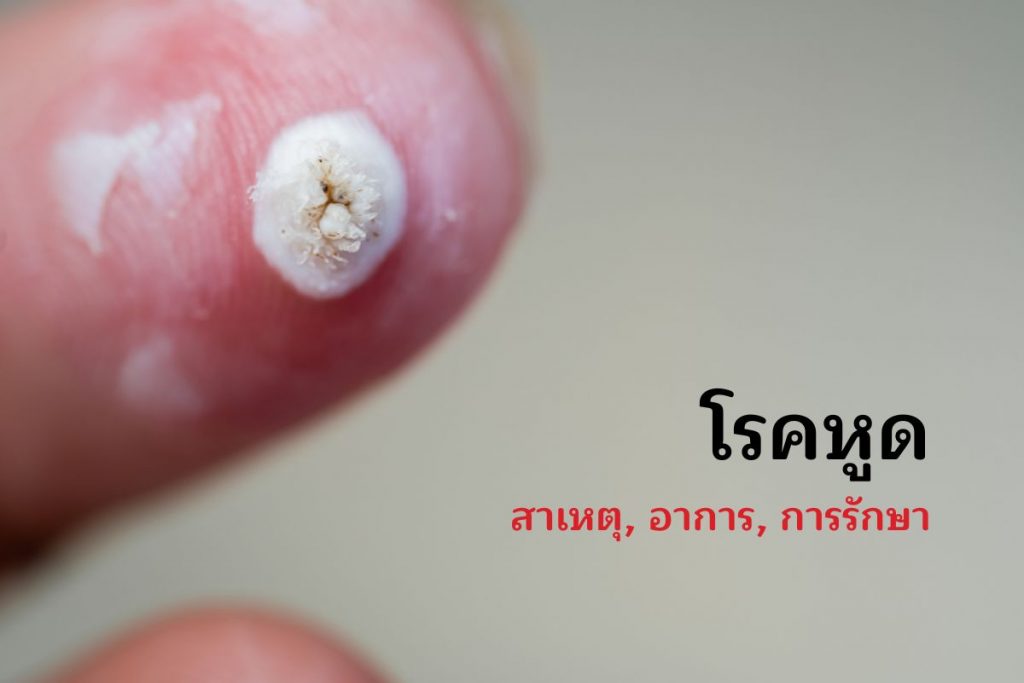 โรคหูด สาเหตุ, อาการ, การรักษา