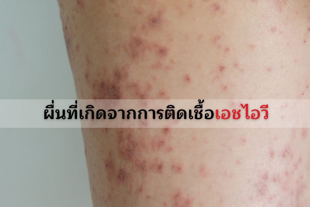 ผื่นที่เกิดจากการติดเชื้อเอชไอวี