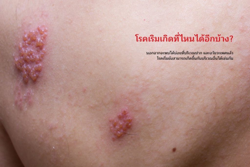โรคเริมเกิดที่ไหนได้อีกบ้าง