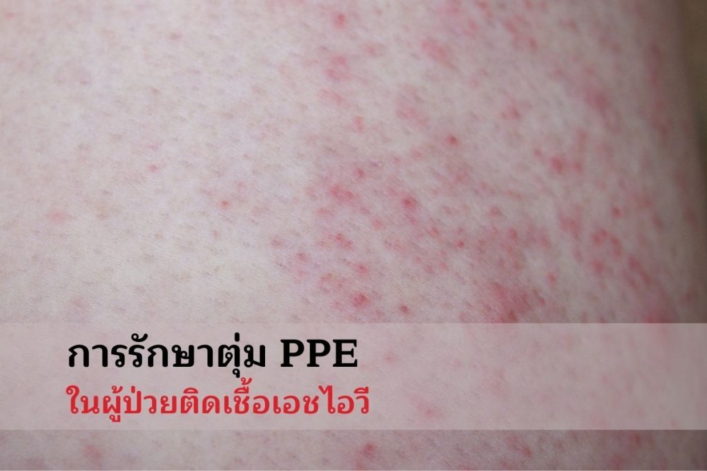 การรักษาตุ่ม PPE ในผู้ป่วยติดเชื้อเอชไอวี