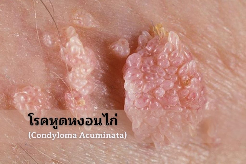 โรคหูดหงอนไก่ (Condyloma Acuminata)