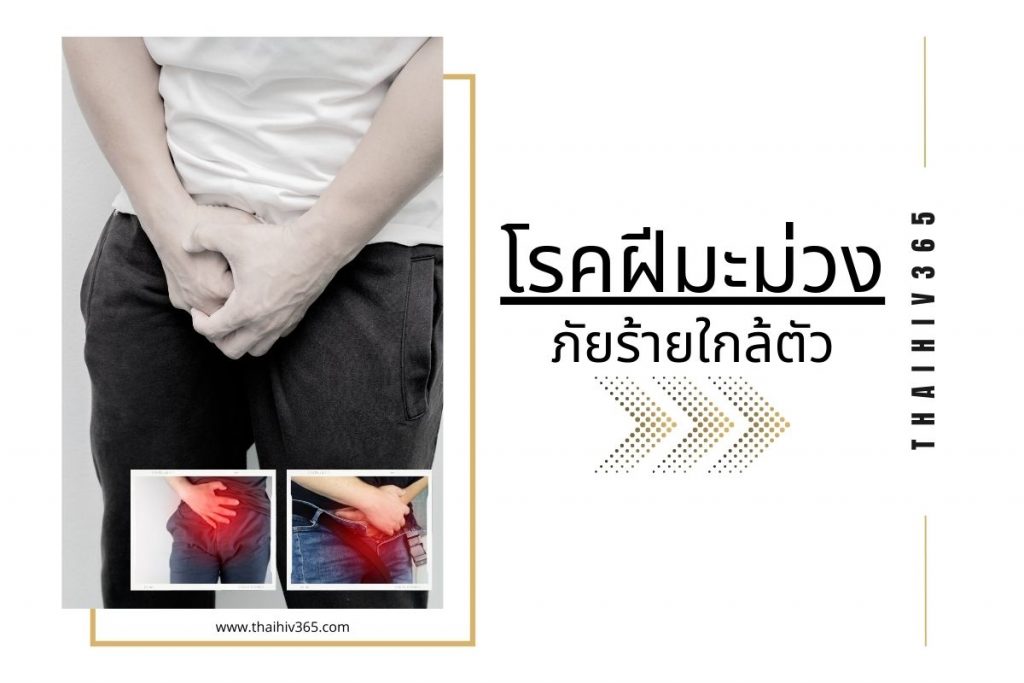 โรคฝีมะม่วง..ภัยร้ายใกล้ตัว
