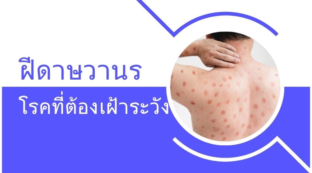 ฝีดาษวานร | โรคที่ต้องเฝ้าระวัง