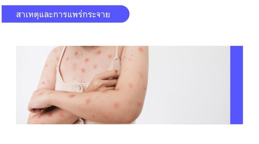 สาเหตุและการแพร่กระจาย