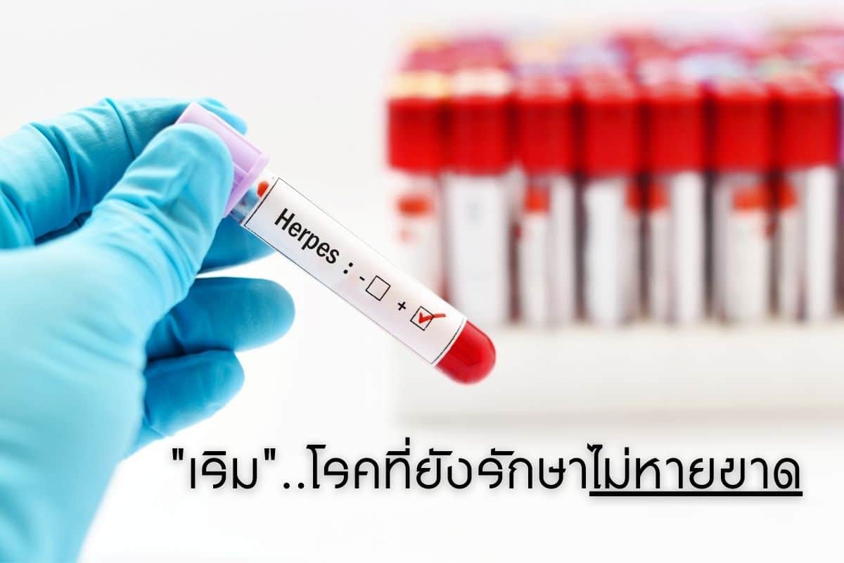 เริม โรคที่ยังรักษาไม่หายขาด