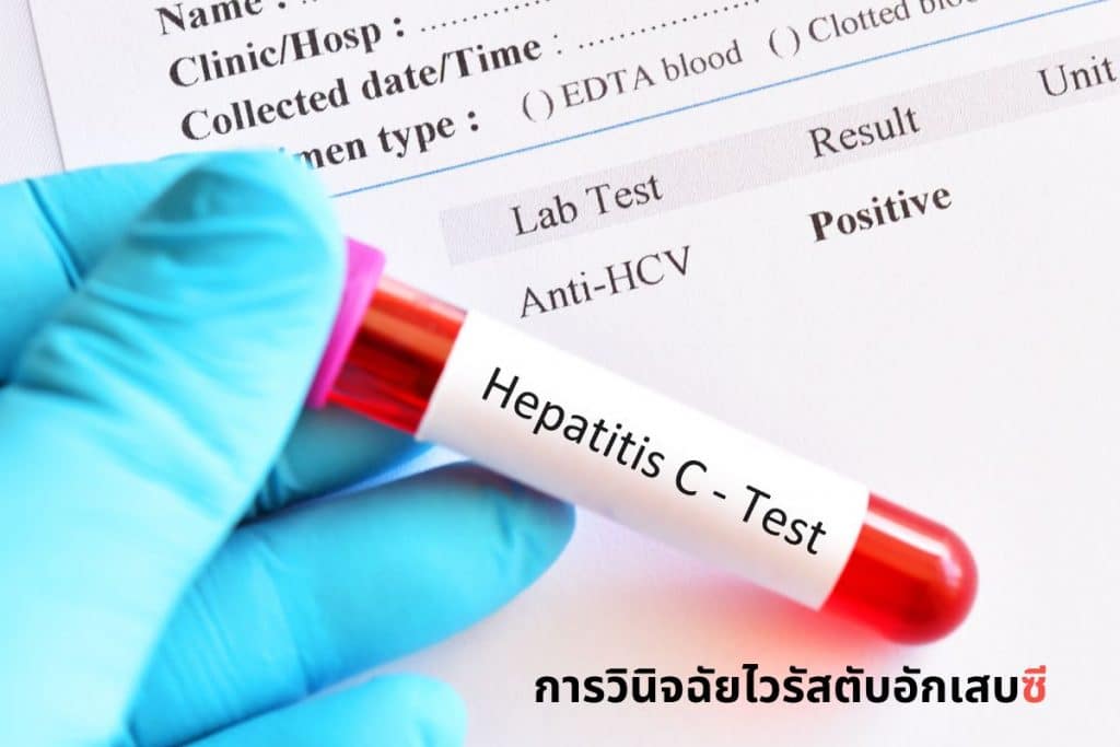 การวินิจฉัยไวรัสตับอักเสบซี