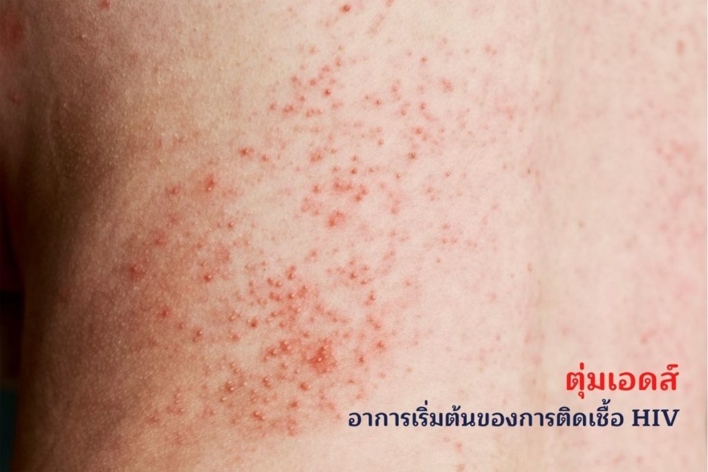 อาการ HIV เป็นอย่างไร? เป็นเอดส์รักษาหายไหม?