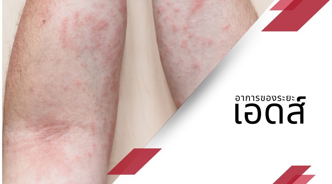 เอดส์ (AIDS) ระยะสุดท้ายของการติดเชื้อเอชไอวี