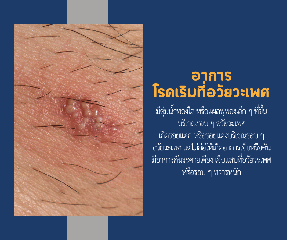 โรคเริมที่อวัยวะเพศ ทำไมเป็นแล้วไม่หายขาด