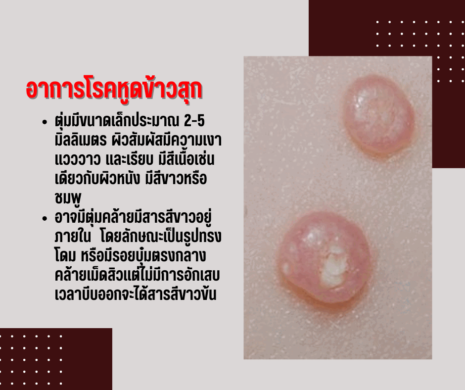 โรคหูดข้าวสุก ติดต่อง่าย แต่ก็รักษาได้