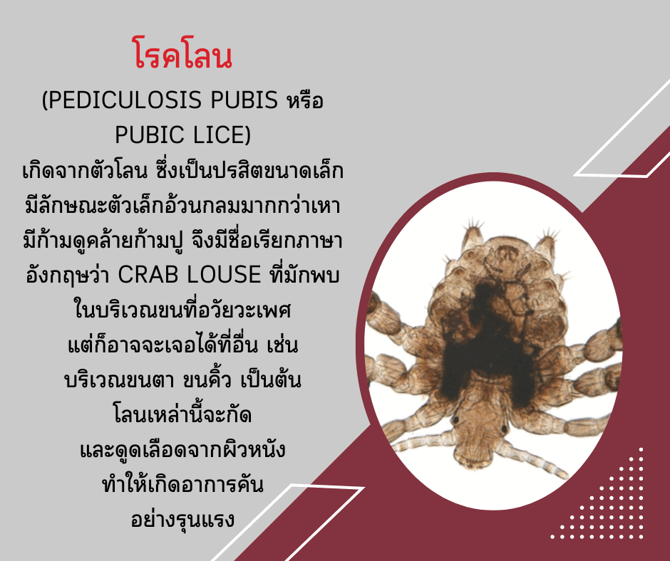 อาการคันในที่ลับ ตรวจดูอาจเป็นโรคโลน