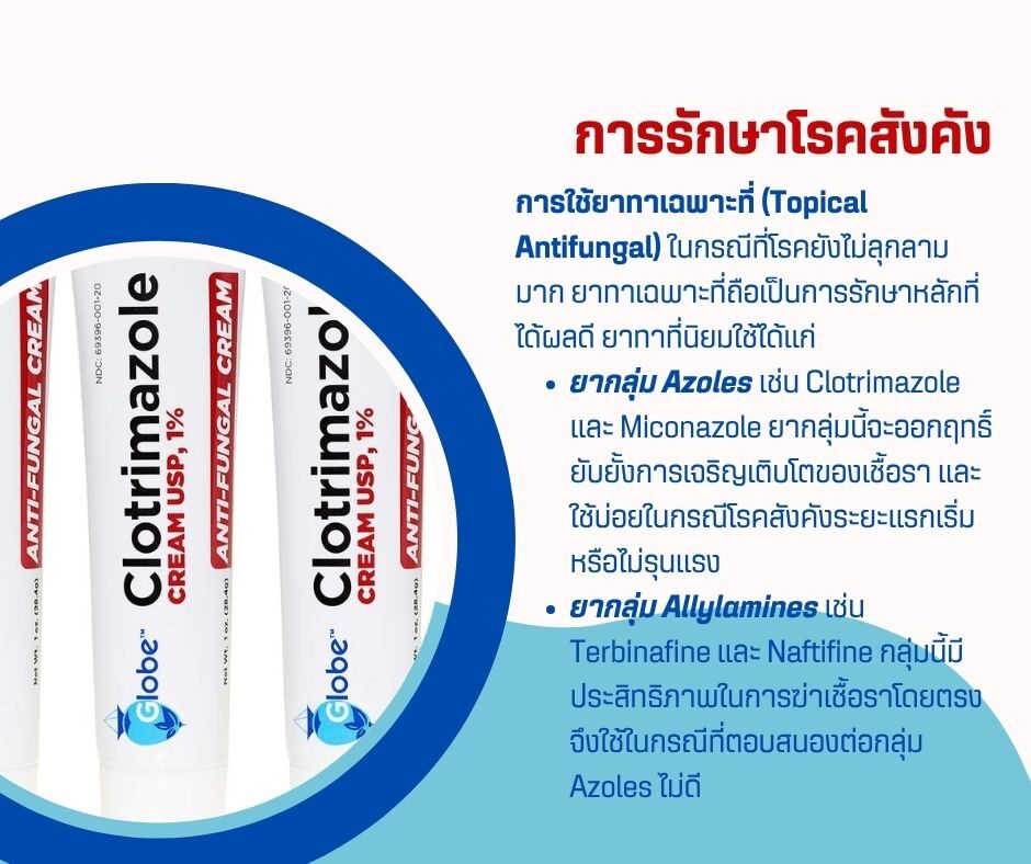 การรักษาโรคสังคัง