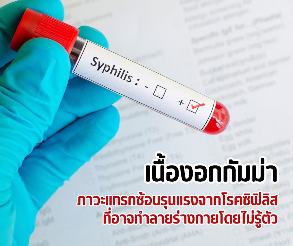 เนื้องอกกัมม่า ภาวะแทรกซ้อนรุนแรงจากโรคซิฟิลิส ที่อาจทำลายร่างกายโดยไม่รู้ตัว