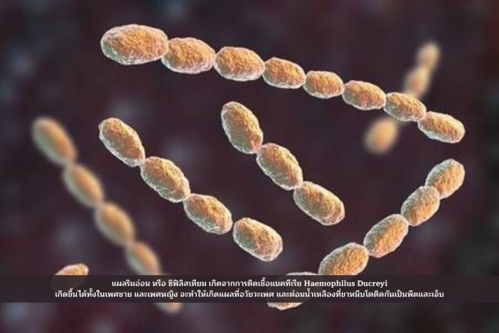 โรคแผลริมอ่อน สาเหตุ อาการ การรักษา