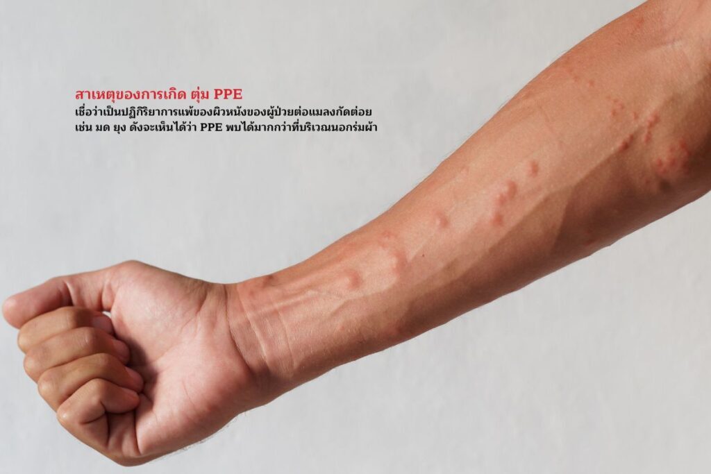 PPE เกิดจากอะไร?