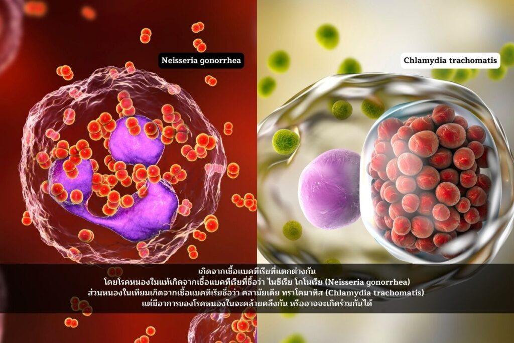 ความแตกต่างระหว่างโรคหนองในแท้ และโรคหนองในเทียม