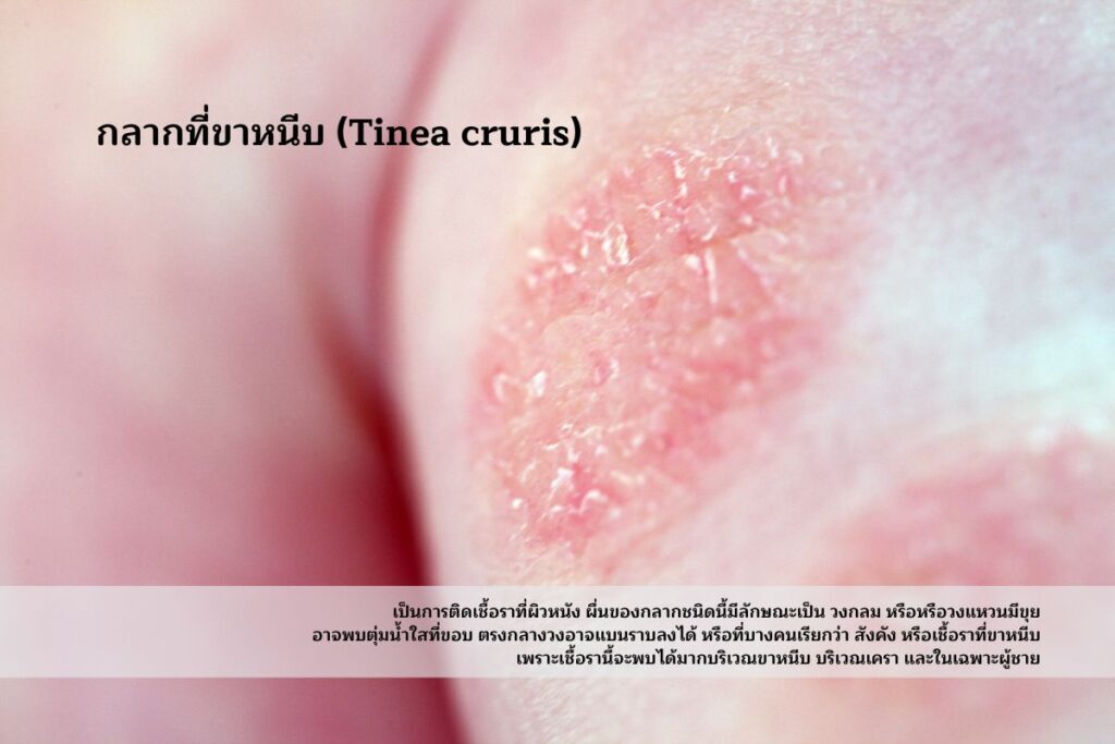 โรคผิวหนังบริเวณจุดซ่อนเร้นที่ควรระวัง