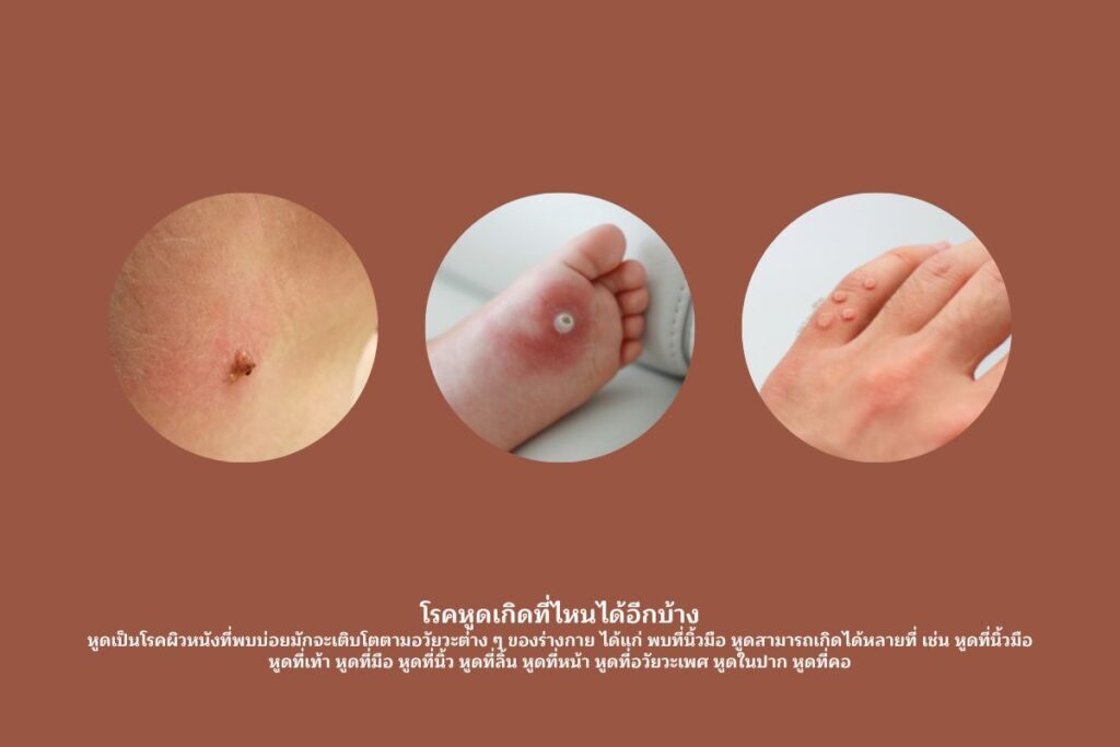 โรคหูดเกิดที่ไหนได้อีกบ้าง