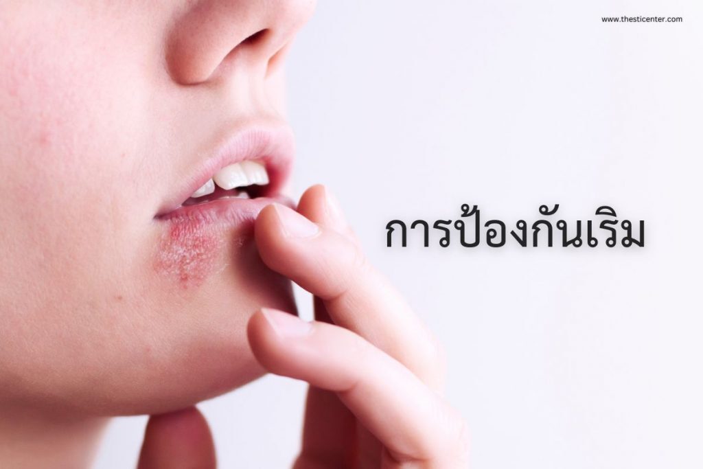 การป้องกันเริม