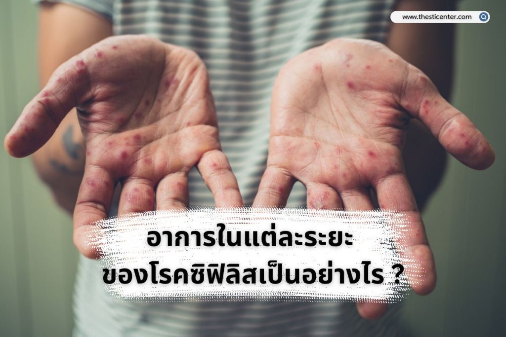 อาการในแต่ละระยะ ของโรคซิฟิลิสเป็นอย่างไร ?