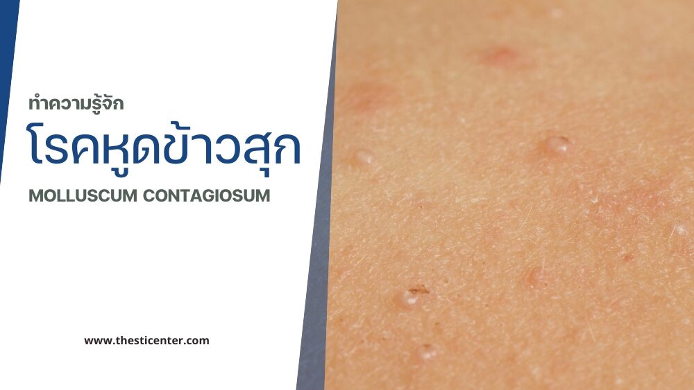 โรคหูดข้าวสุก