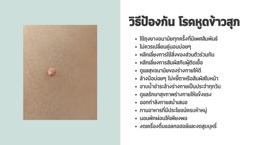 วิธีป้องกัน อาการหูดข้าวสุก