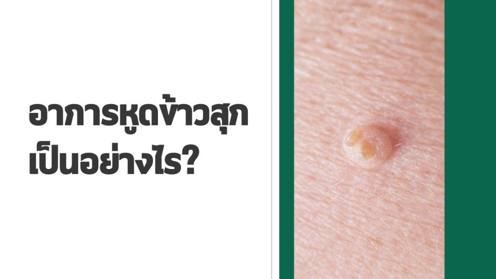 อาการหูดข้าวสุก เป็นอย่างไร