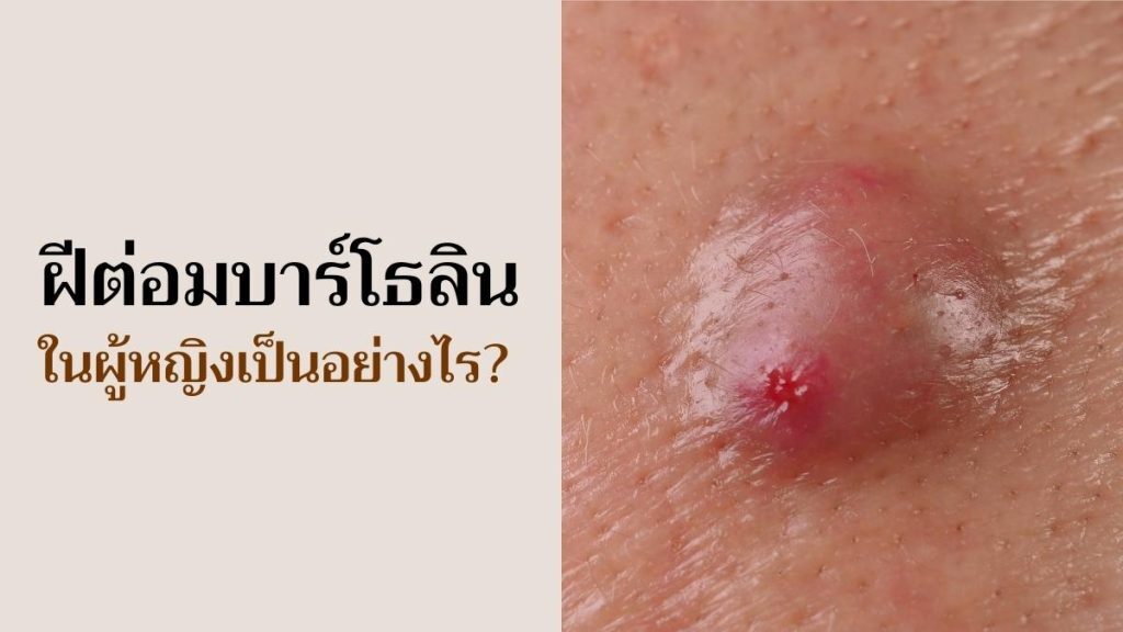 ฝีต่อมบาร์โธลิน ในผู้หญิง