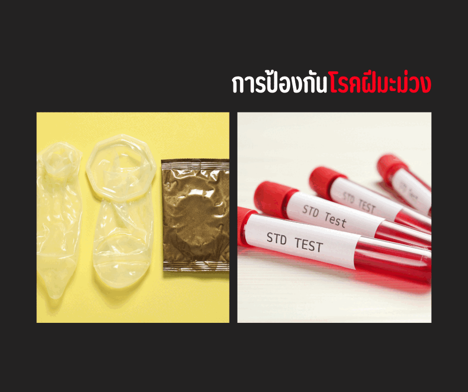 การป้องกันโรคฝีมะม่วง