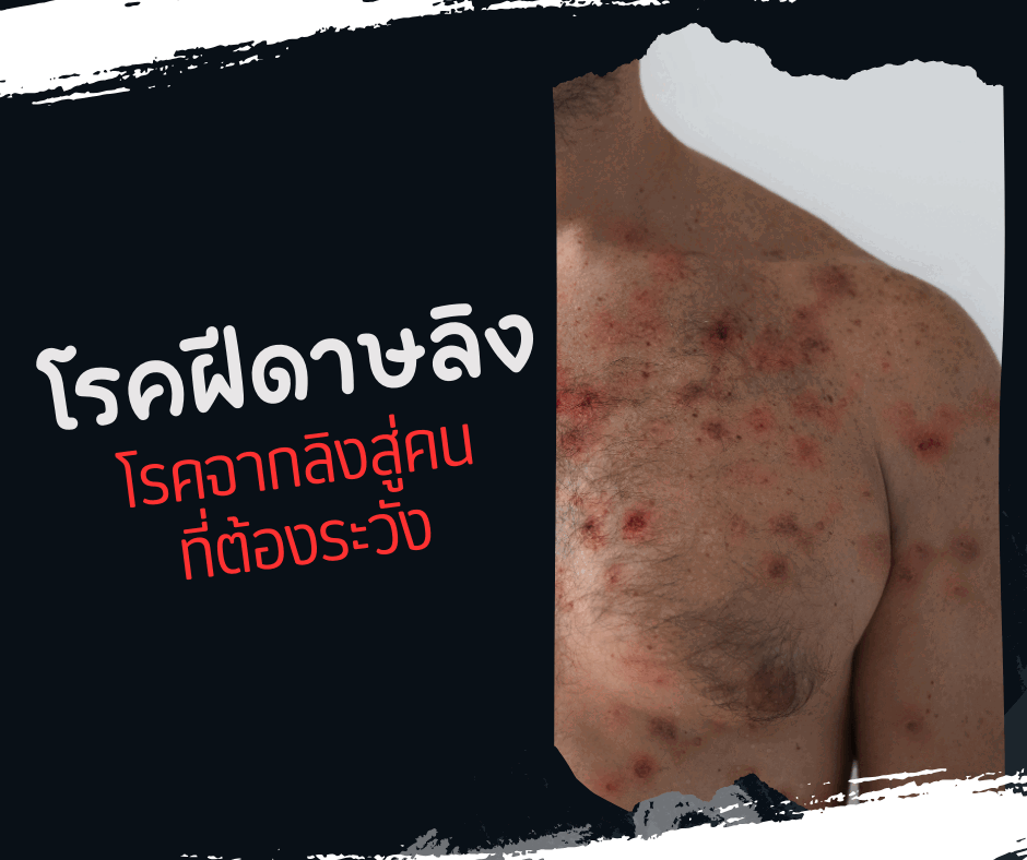  โรคฝีดาษลิง โรคจากลิงสู่คน ที่ต้องระวัง