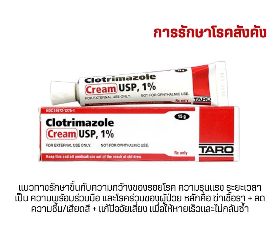 การรักษาโรคสังคัง