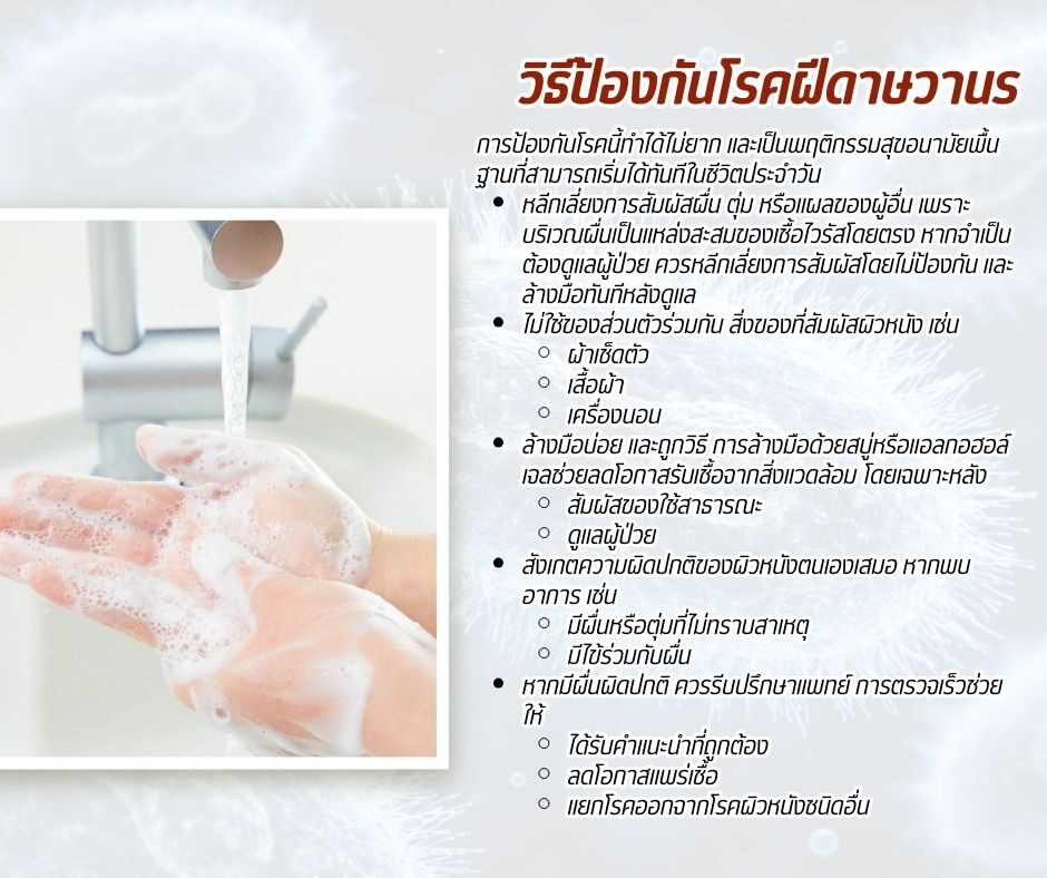 วิธีป้องกันโรคฝีดาษวานร