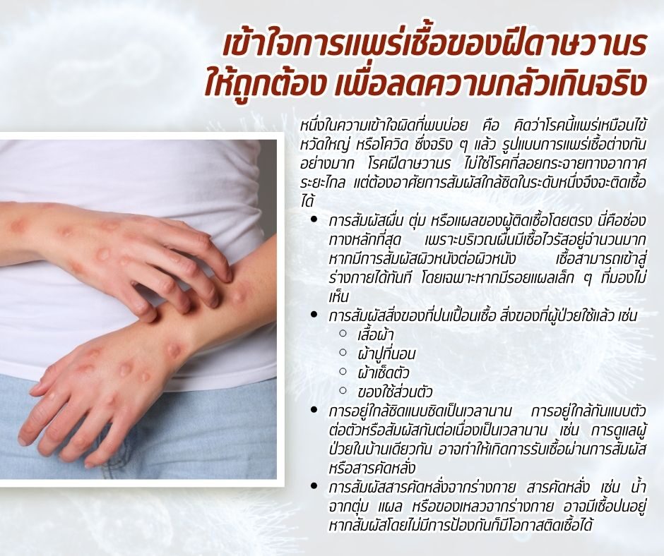 เข้าใจการแพร่เชื้อของฝีดาษวานรให้ถูกต้อง เพื่อลดความกลัวเกินจริง