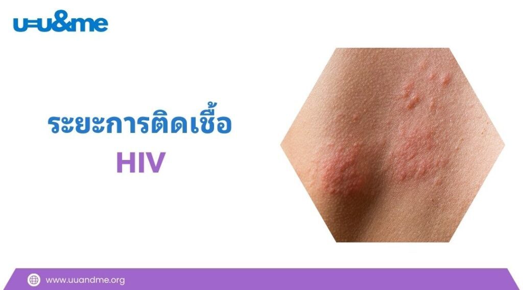HIV รักษาได้ แค่กินยา