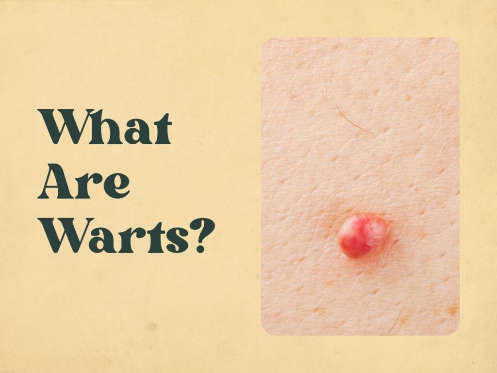 What are warts?