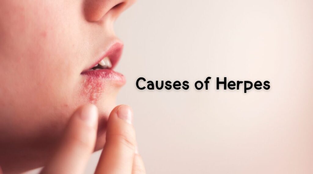 Herpes Simplex Virus : HSV