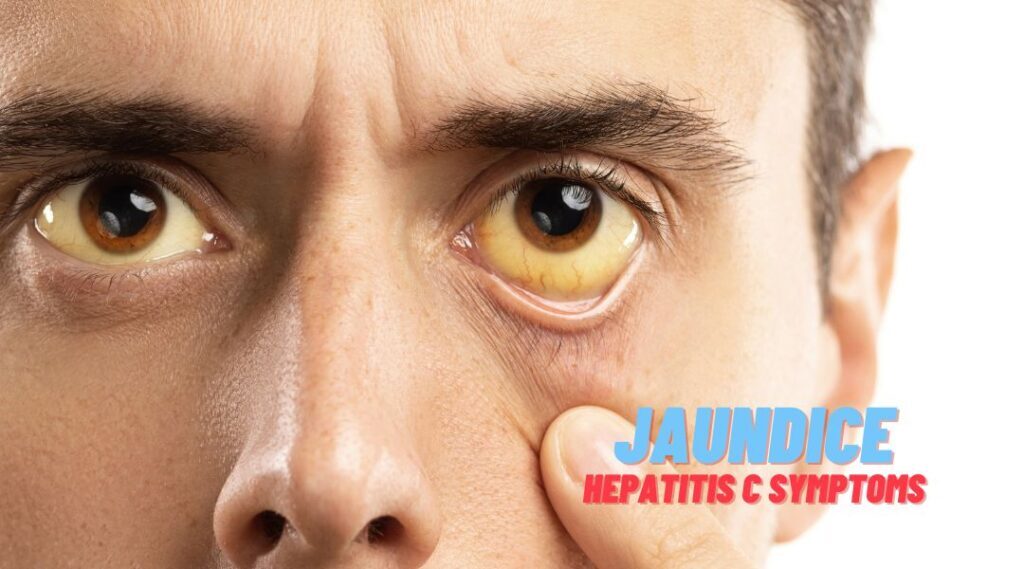 Jaundice Hepatitis C Symptoms
