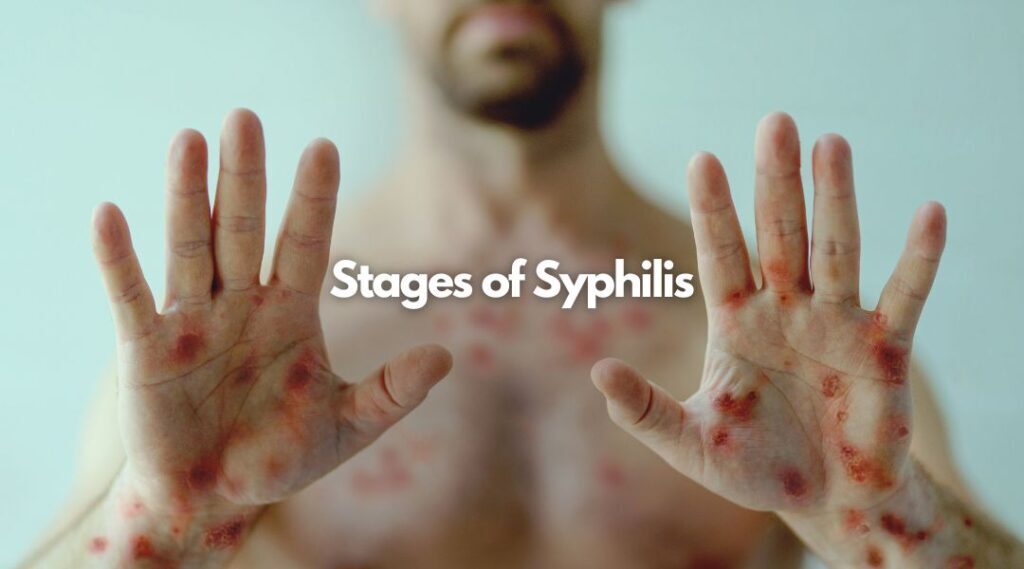 Unveiling the Symptoms of Syphilis